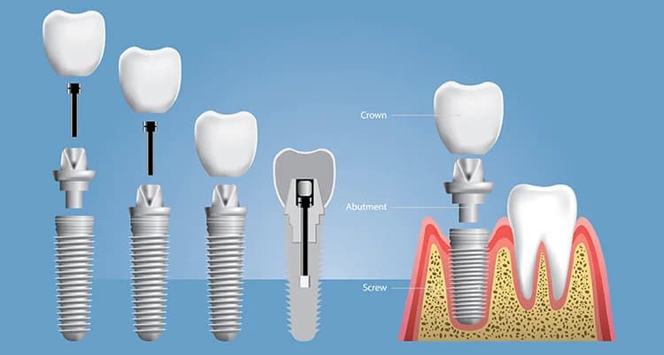 Dental Implant 1