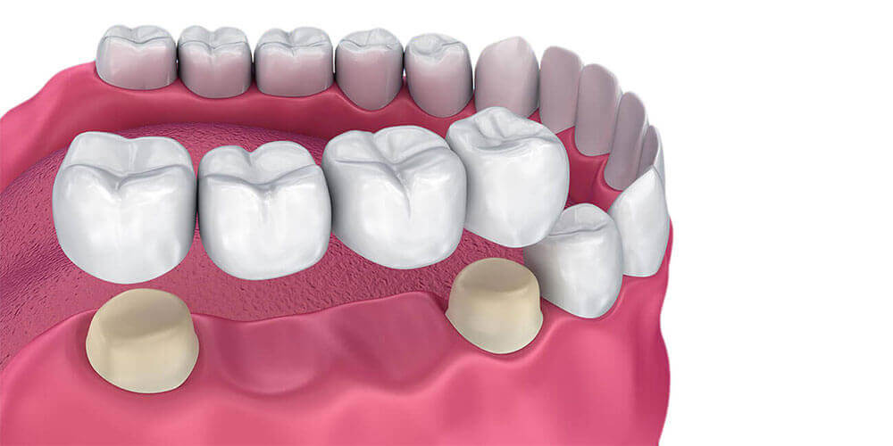 Dental Bridges Brockville