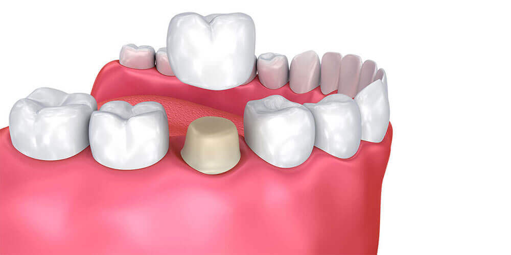Dental Crowns Brockville