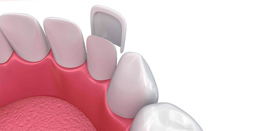 Dental Veneers Brockville