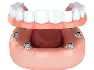 Implant Supported Dentures 1